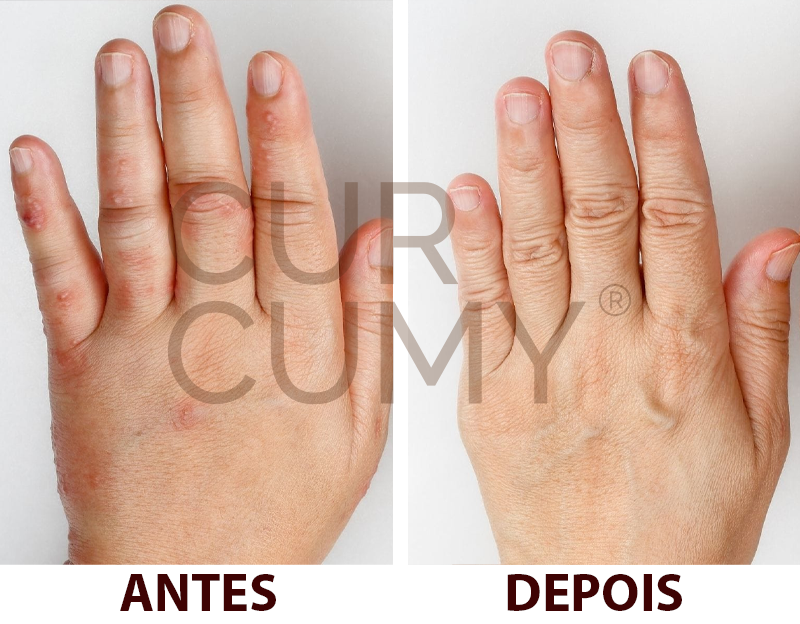 imagens de antes e depois de utilizar o curcumy