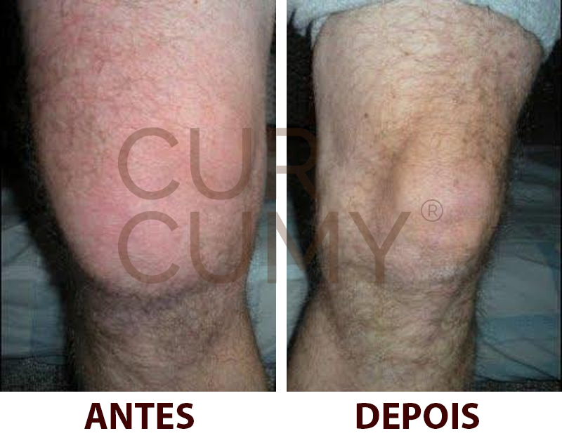 efeitos do curcumy em gotas original